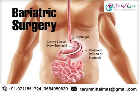 best bariatric surgeon in delhi ncr