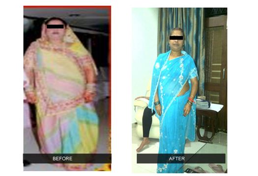 Weight Lose Surgery in Delhi