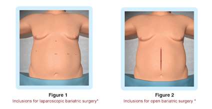 Best Weight Lose Surgery Center in India