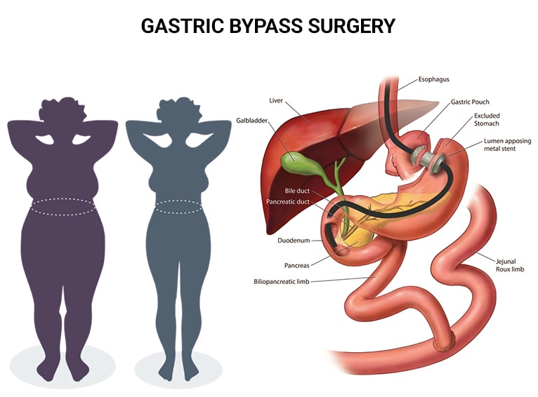 Best Sleeve Gastrectomy Surgeon in India