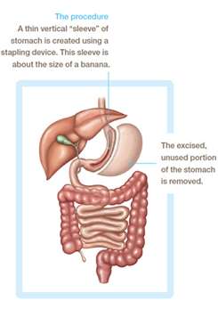 Best Sleeve Gastrectomy Surgeon in India